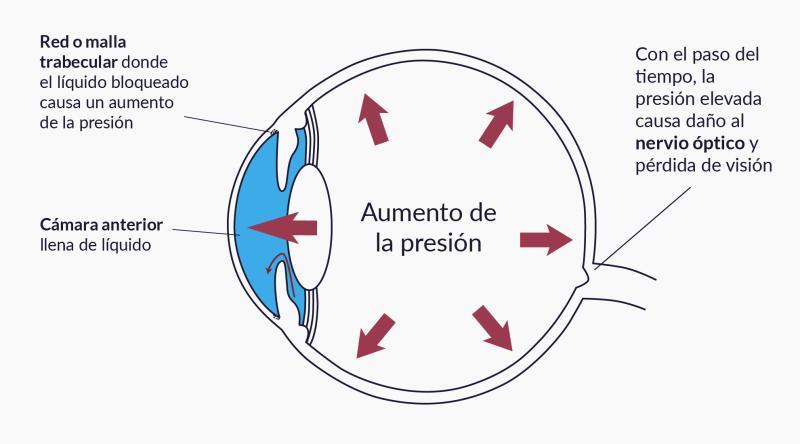 Diagrama de cómo aumenta la presión ocular en el glaucoma